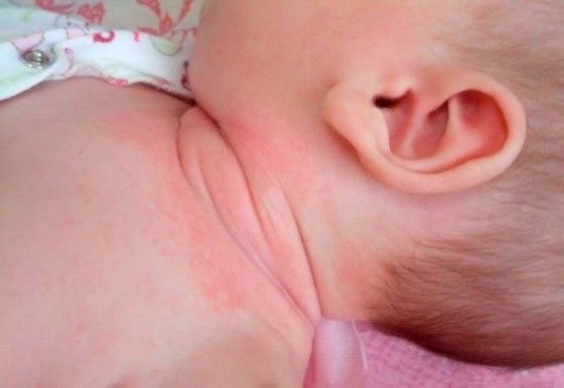 Потница у новорожденных: как выглядит и чем лечить? | Nestlé Baby&Me